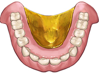 金属床義歯2